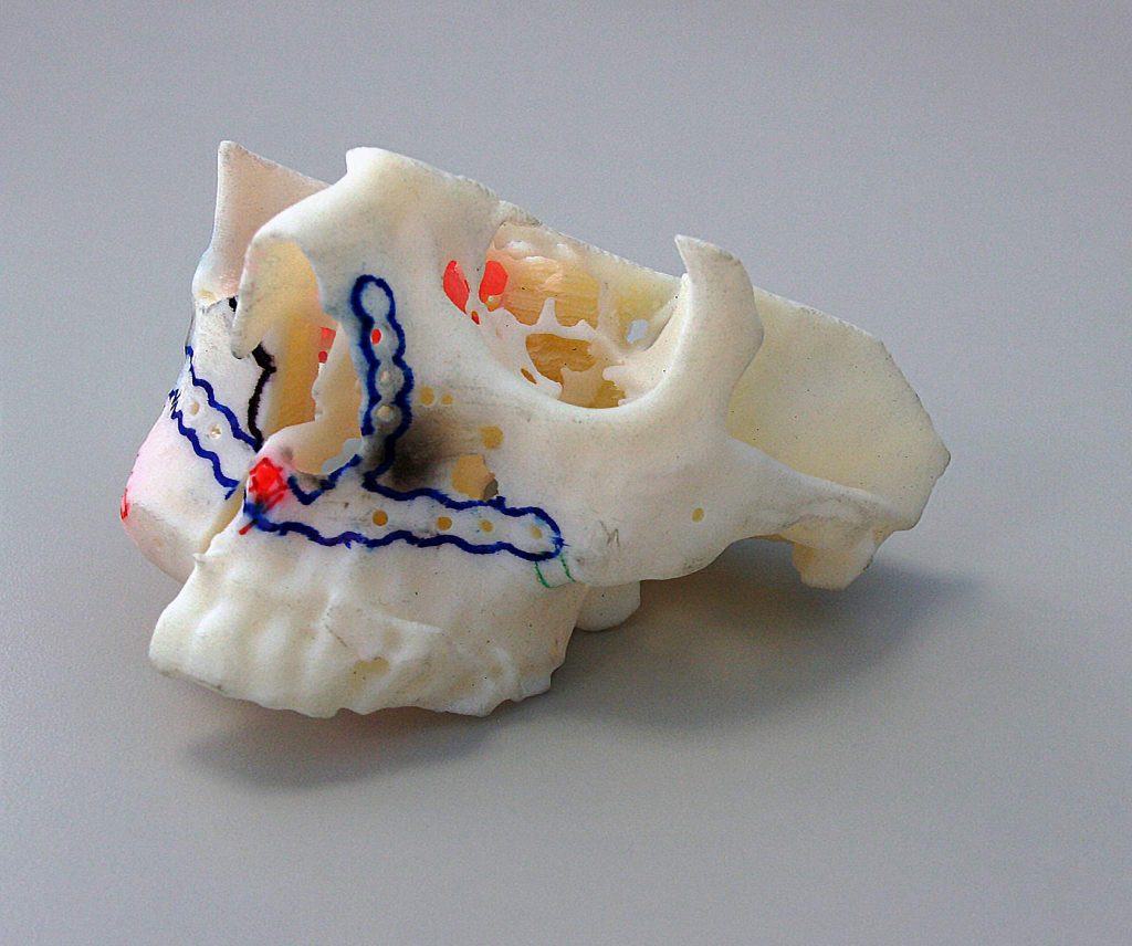 Stratasys 3D打印机可以创建患者解剖结构的精确复制品，并允许定制的配件和预弯曲。通过Stratasys的照片。