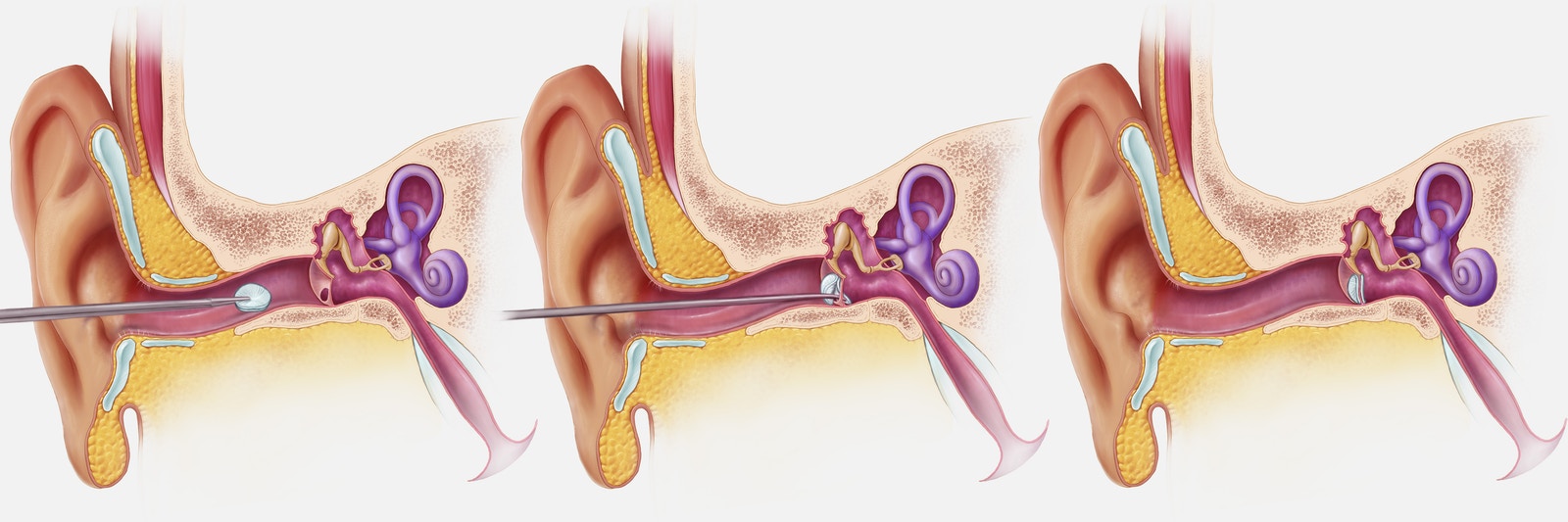 The noninvasive process by which the PhonoGraft is installed through the ear canal. Image via Shawna Snyder / Wyss Institute.