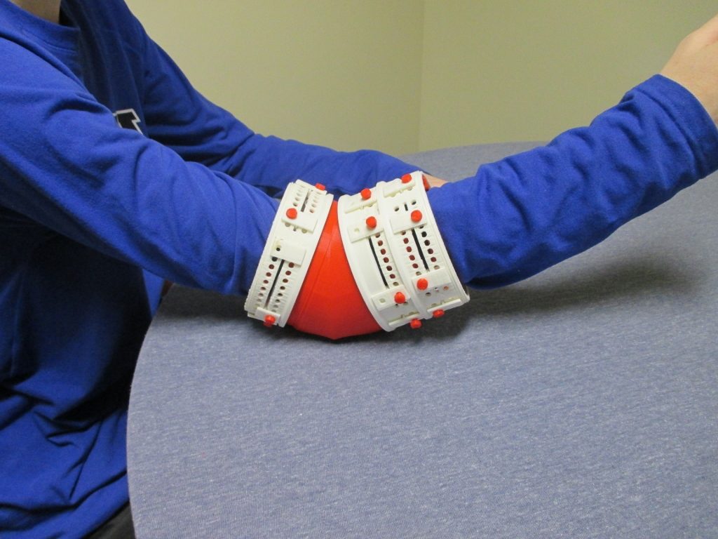 大专院校的一等奖获得者冠军铸造，适合儿童肘部。托马斯·索尔弗森（Thomas Salverson）的照片。