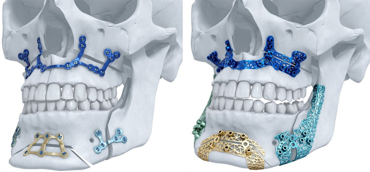 Materialise 3D打印钛颌面部植入物，由DePuy Synthes发布。图片通过Materialise NV在Twitter上发布