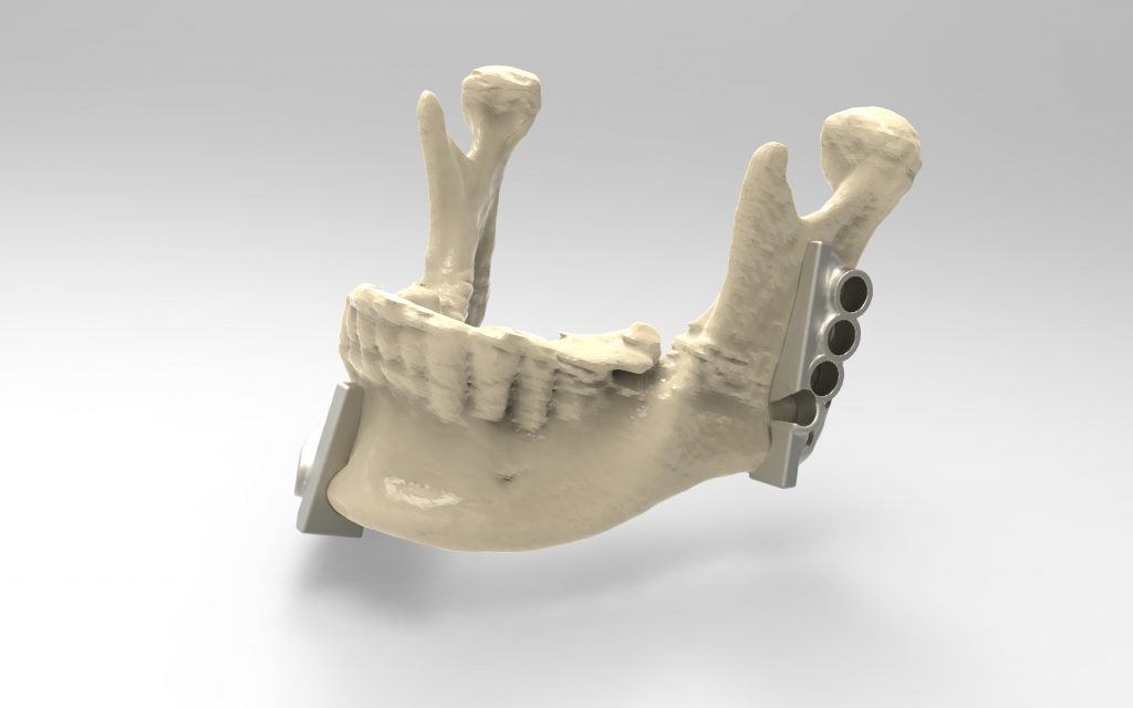 3D printed cutting/drilling guides show where the surgeon can precisely measure where the jaw will be cut and drill holes to fit the mandible plate. Image via Renishaw.