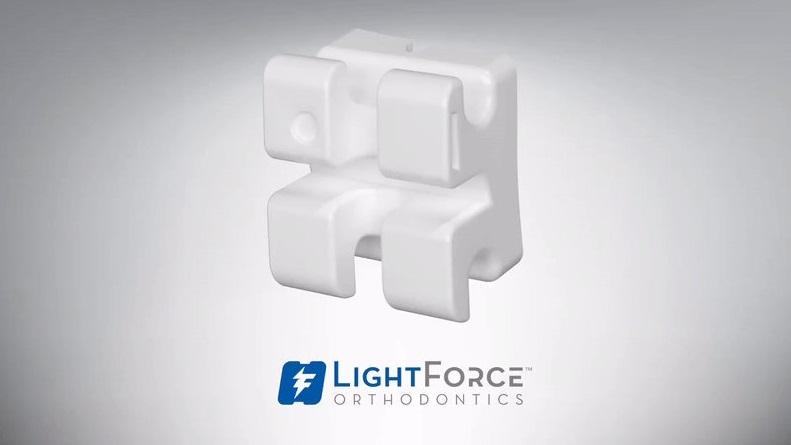 Lightforce正畸技术的3D打印支架。通过Lightforce正畸照片照片。