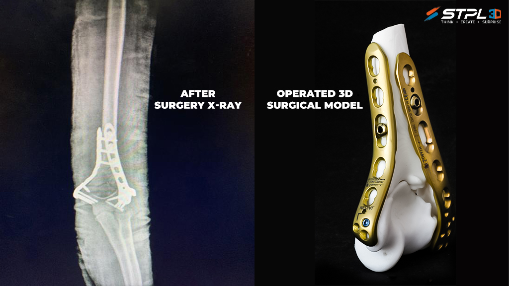 Jignesh Pandya博士和STPL3D博士从树脂中产生了特定于患者的印刷肘骨，以指导手术过程。通过STPL3D的照片