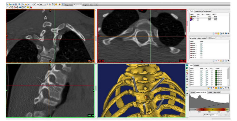 通过3D成像显示了螺丝螺丝插入的角度。图像通过骨科手术杂志。