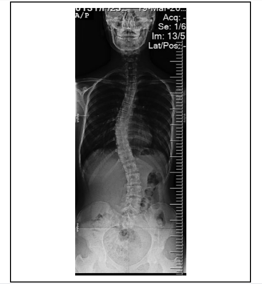 计算机断层扫描评估表明已经实现了精确的椎弓根螺钉固定。图像通过骨科手术杂志。