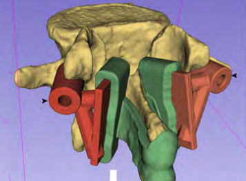 医生3D打印的脊柱手术指南的3D模型。雷竞技官网登录