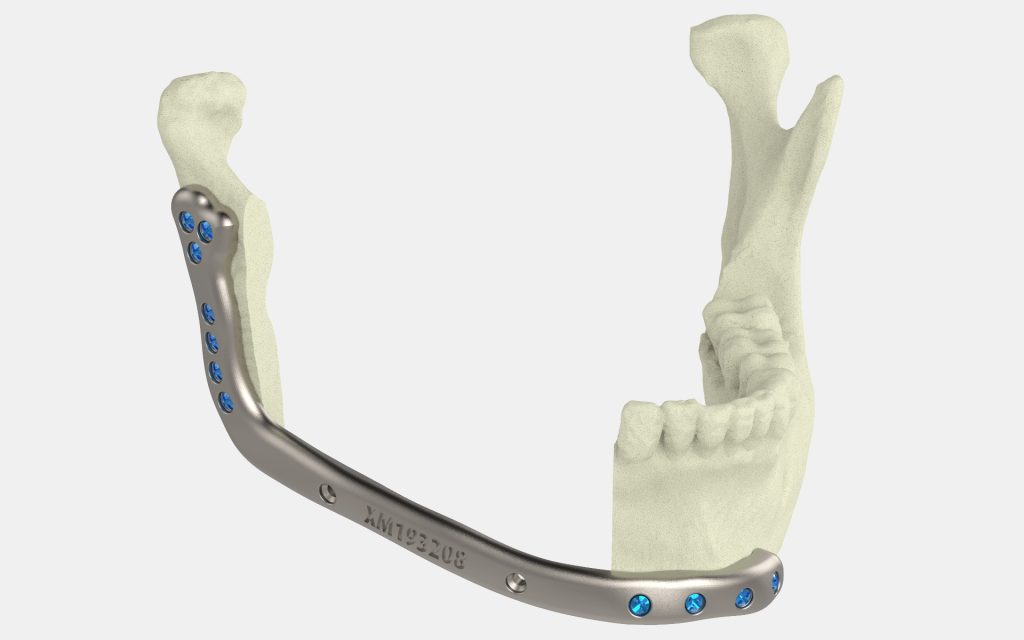 下颌骨板的一个例子。通过Xilloc照片。