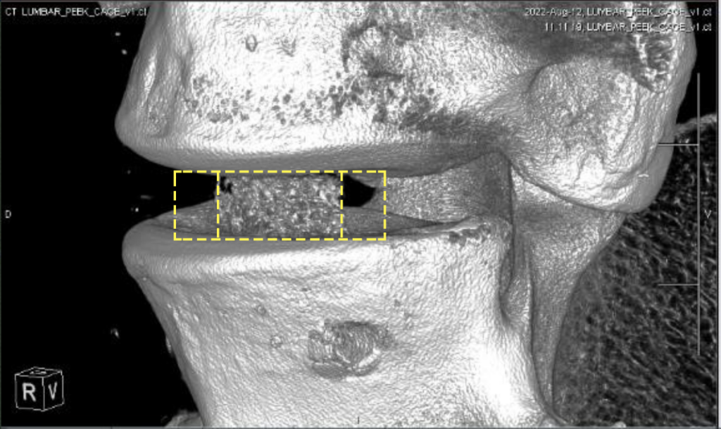 邦德3D印刷的脊柱笼的CT图像。图像通过Bond3D。